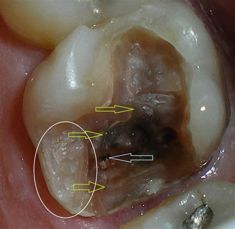This is because many of the signs can only be determined by a trained dentist. Do I really need a root canal? - Strong Family Dentistry ...