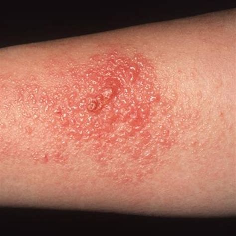 Skin Problems Contagious Rashes Bumps And Blisters