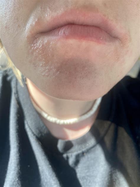 Itchy Little Bumps On Face And Spreading Dermatologyquestions