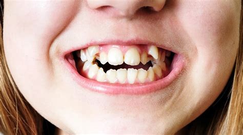 What Causes Crooked Teeth 8 Big Reasons For Crooked Teeth Franklin