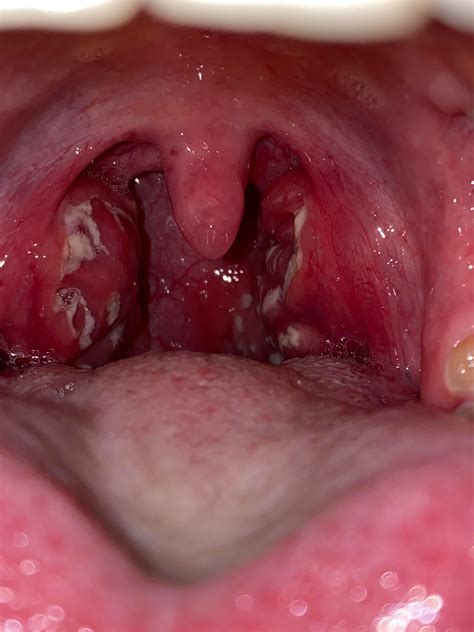 Are These Tonsil Stones Came Back Negative For Strep Throat My Throat