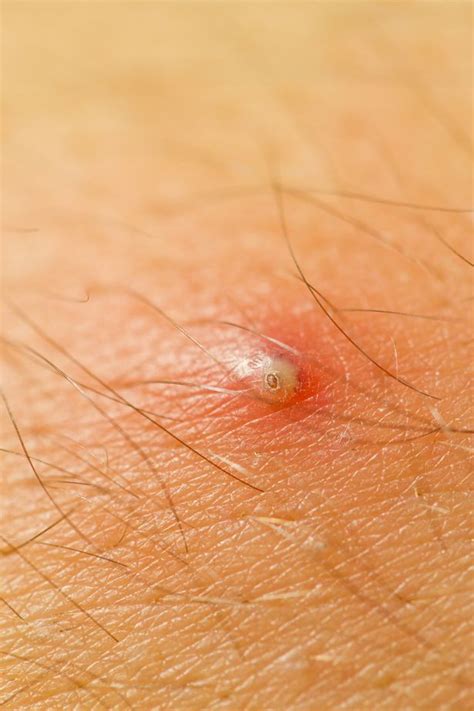 Pimples On Vagina From Ingrown Hair Bumps Pimples Acne Zits Scabs My