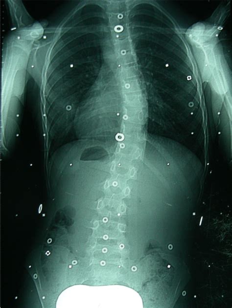 Scoliosis In Adults Scoliosis Brace