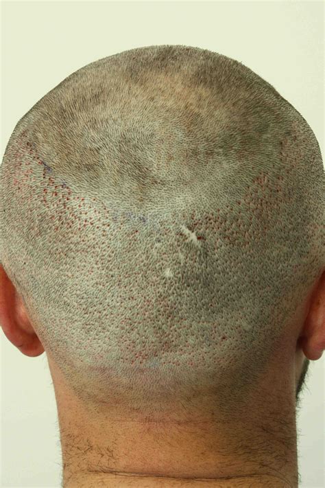 Post Op Recovery Photographs 2 Weeks After Fue Hair Transplant Procedure