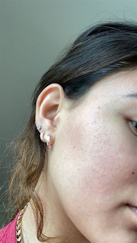 Tiny Bumps Rash On Cheek Beauty Insider Community