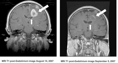 Mri Scans Showing A Typical Response Of A Recurrent Gbm To Bevacizumab