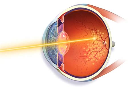 Retinal Laser Therapy Retina Laser Treatments For Diabetes