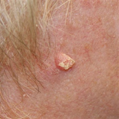 Skin Cancer Understanding Squamous Cell Carcinoma