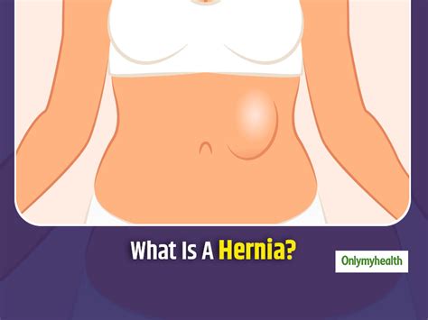 Understanding All About Hernia Causes Symptoms Treatment And