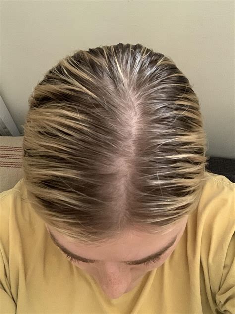 Should I Be Concerned About This Hair Loss Thinning FemaleHairLoss