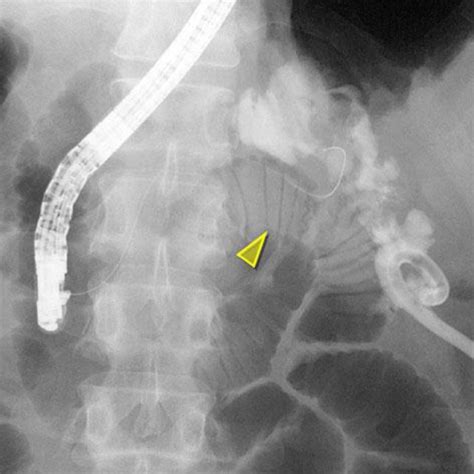 Drainage Tubography Showed A Fistula Of The Colon At The Splenic