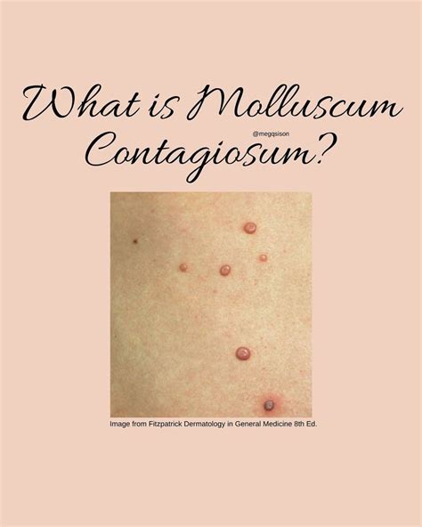 What Is Molluscum Contagiosum Dermatology Skin Problems Skin