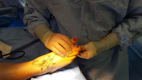 Hammertoe Surgery Foot Doctor San Diego La Jolla Podiatrist
