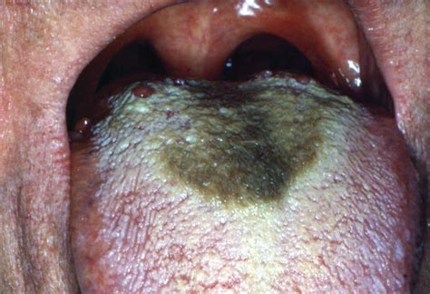 Pigmented Lesions Of The Oral Mucosa Pocket Dentistry