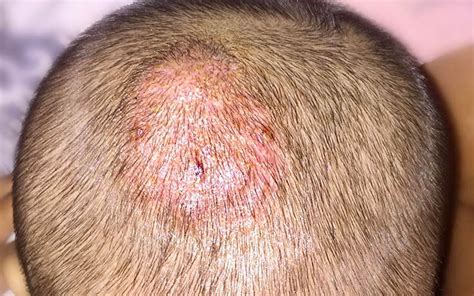 Scalp Infections 6 Types And Ayurvedic Ways To Treat Them Vedix