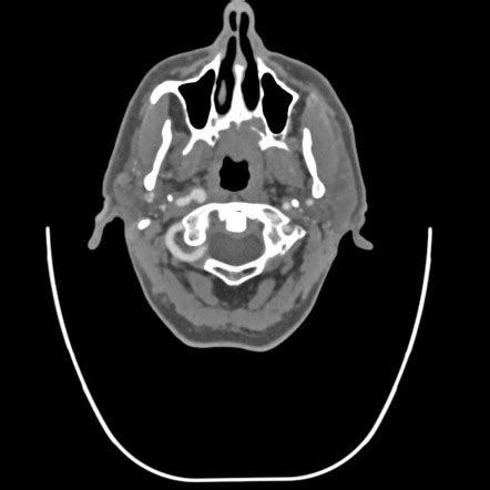 Internal Carotid Artery Dissection Radiology Reference Article Radiopaedia Org