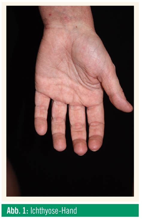 Der wichtigste behandlungsansatz ist die vermeidung von auslösenden substanzen (keine wolle, handschuhe beim umgang mit reinigungsmitteln etc.) und mechanischer reizung der haut. Das atopische Ekzem aus Sicht des ­Kinderdermatologen ...