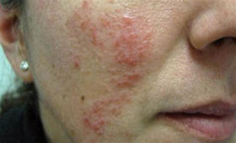 Whats The Difference Between Acne And Rosacea North York General