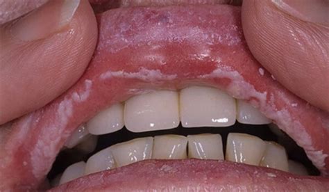 Candidiasis Of The Mouth And Corners Of The Mouth Photo Causes And