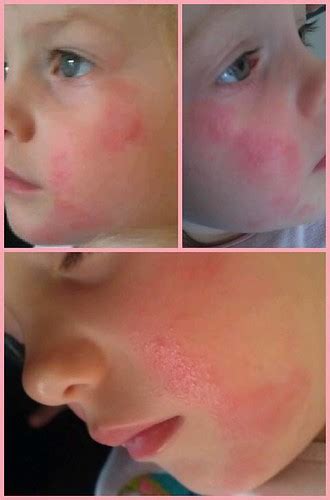 Infant Face Rash Allergic Reaction To Methylisothiazolino Flickr
