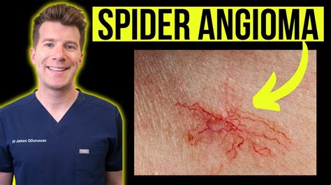 Doctor Explains Spider Angioma Aka Spider Nevustelangiectasia
