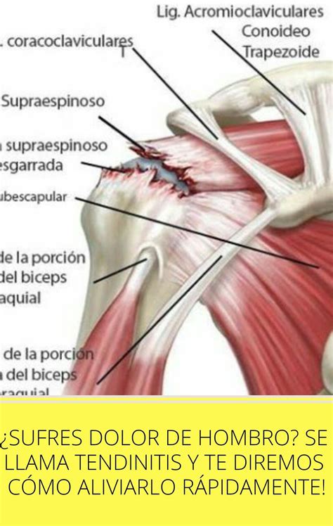 Sientes dolor en tú hombro Es tendinitis y te mostramos unos consejos