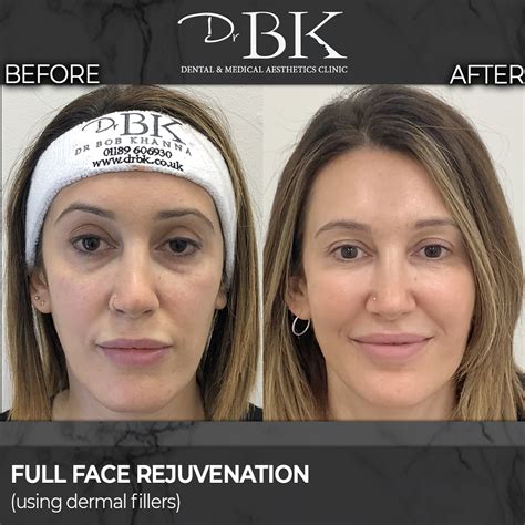 Before And After Gallery Drbk Cosmetic Dentist And Aesthetics Clinic