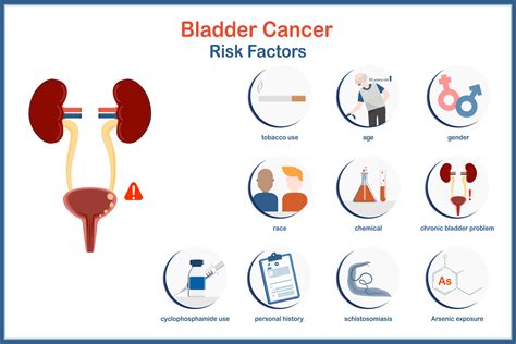 Medical Vector Illustration In Flat Style Infographic Bladder Cancer