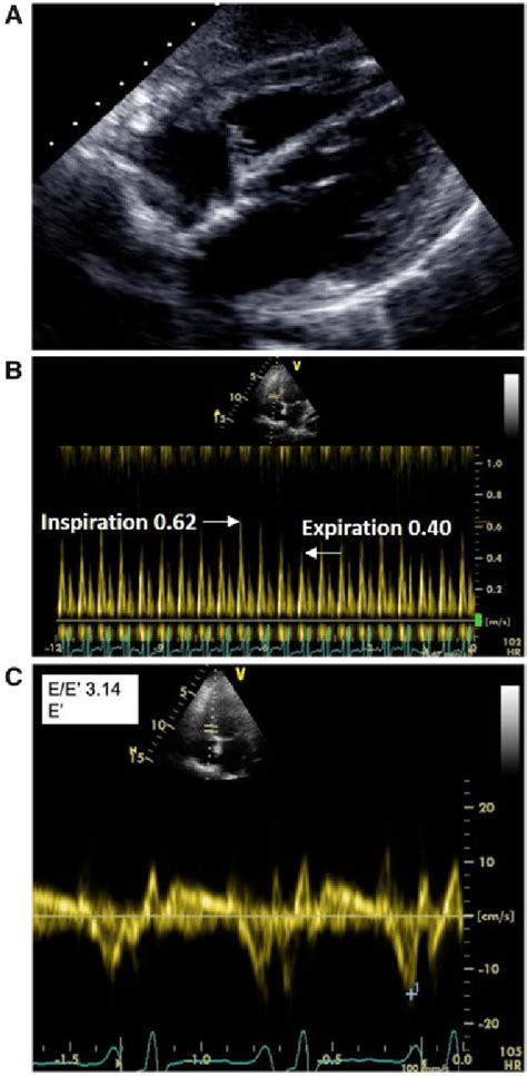 Transthoracic Echocardiography At Presentation A Subcostal
