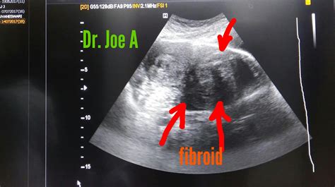 Ultrasound Imaging Cervical Fibroid A Large One