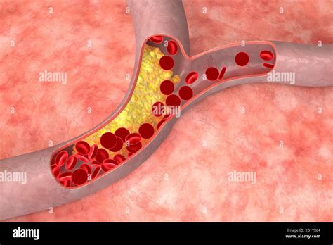 Atherosclerosis In Artery Medical Concept 3d Illustration Stock Photo