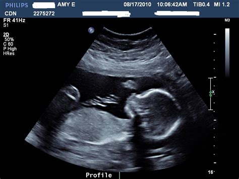 Pretty Babies Post Ultrasound Baby Update