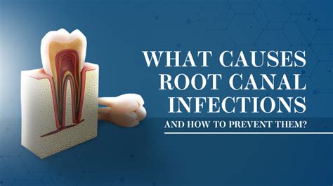 Root Canal Infection Cause And Prevention Springvale Dental Clinic