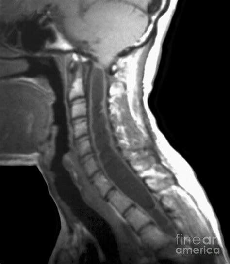 Spinal Cord Cyst Mri Scan Photograph By Zephyr Pixels