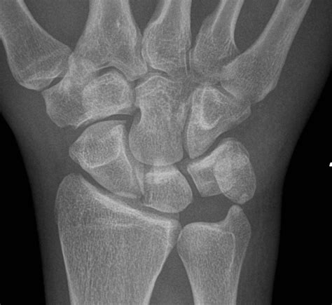 Combined Volar And Dorsal Fracture Pattern Of The
