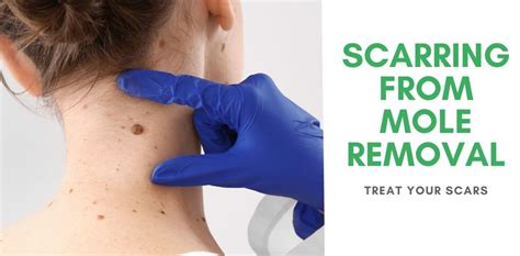 Scarring From Mole Removal Treat Your Scars