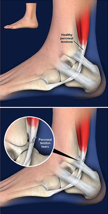 The tendon may even completely tear with severe patellar tendonitis. Peroneal Tendon Tears | Central Coast Orthopedic Medical Group