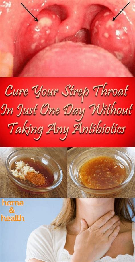 Cure Your Strep Throat In Just One Day Without Taking Any Antibiotics Natural Health