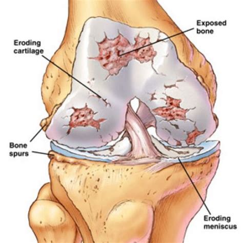 In some types of arthritis, other organs are also affected. Knee Pain from Osteoarthritis - What are the Three ...