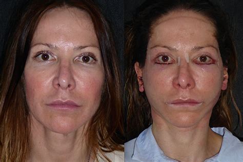 Davina 47 Facelift Neck Lift Lower Eyelid Pinch Surgery Dominic Bray