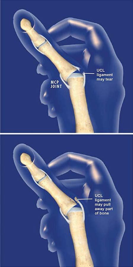 Hand Examination Ulnar Collateral Ligament Injury Of The Thumb Sexiz Pix