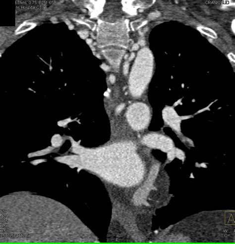 Coarctation Of The Aorta With Impressive Collaterals Vascular Case