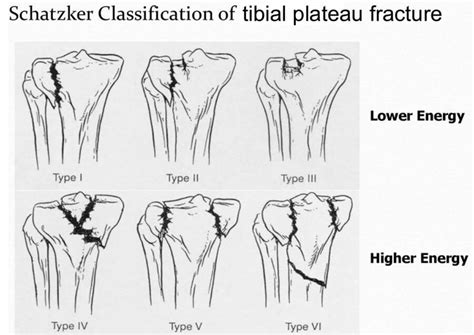 Tibial Plateau Fracture Surgery Symtoms Treatment And Recovery
