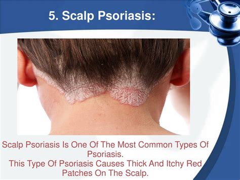 Ppt The Five Main Types Of Psoriasis Powerpoint Presentation Free