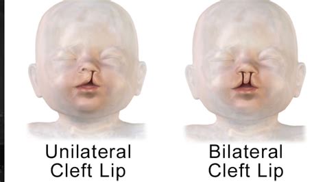 Documentary Cleft Lip And Palate Youtube