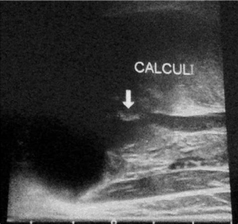 Example Of An Ultrasound Showing A Small Submandibular Sialolithiasis