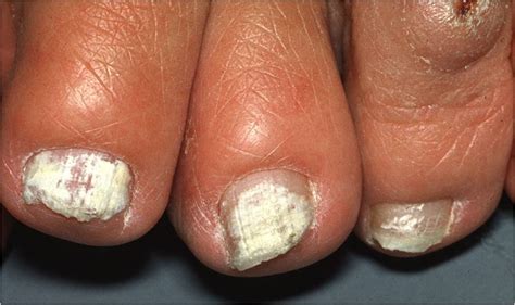 Onychomycosis Tinea Unguium Nail Fungal Infection The Clinical Advisor