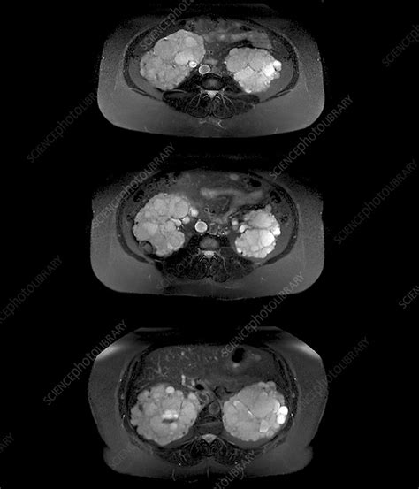 Polycystic Kidney Disease Mri Scans Stock Image C0474800
