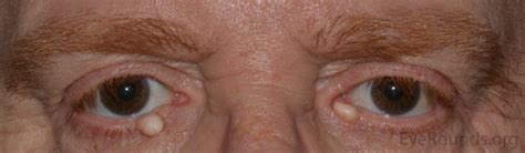 Sebaceous Cyst On Eyelid Cheapest Online Save 47 Jlcatjgobmx