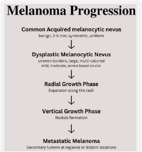 Summary Of Melanoma Progression Based On The Clark Model Of Melanoma